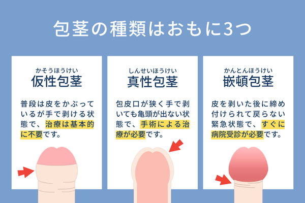 包茎の種類について
