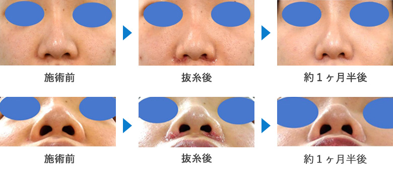小鼻縮小の症例写真ビフォーアフター